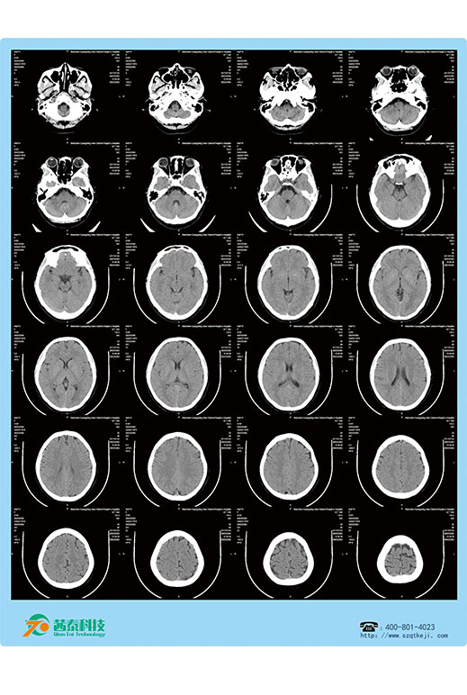 熱敏膠片-CT頭顱.jpg