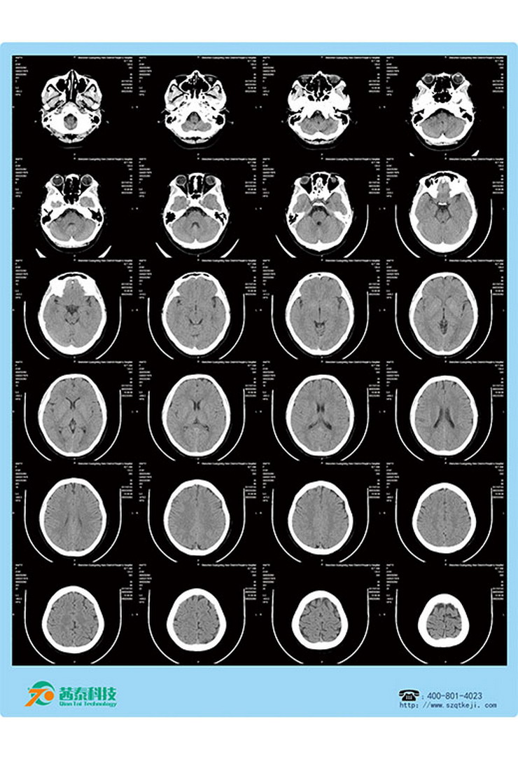 醫(yī)用激光膠片-CT頭顱.jpg